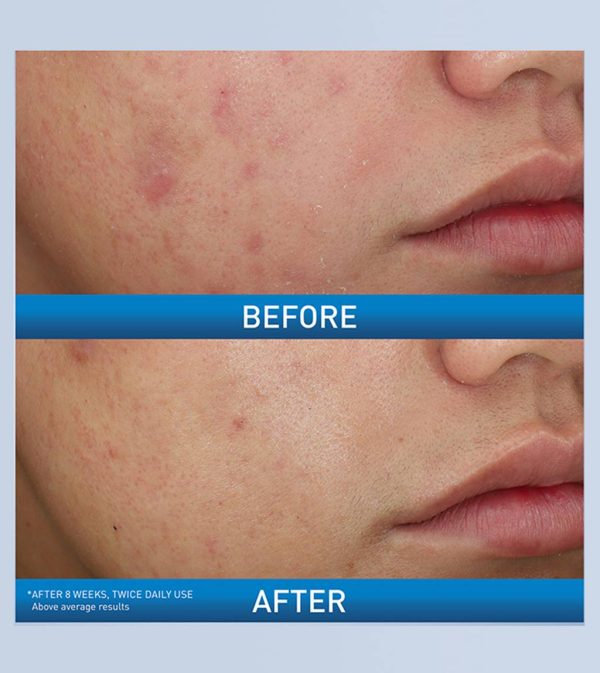 AcneFoaming Cream Wash - Image 3
