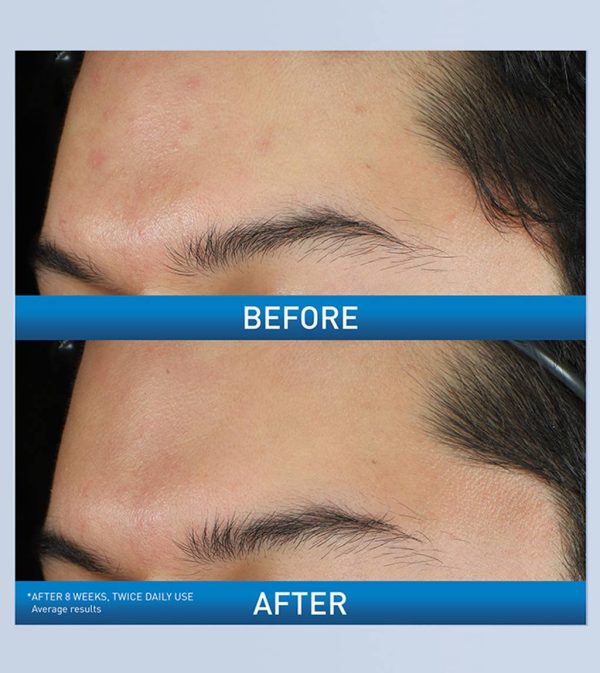 AcneFoaming Cream Wash - Image 4